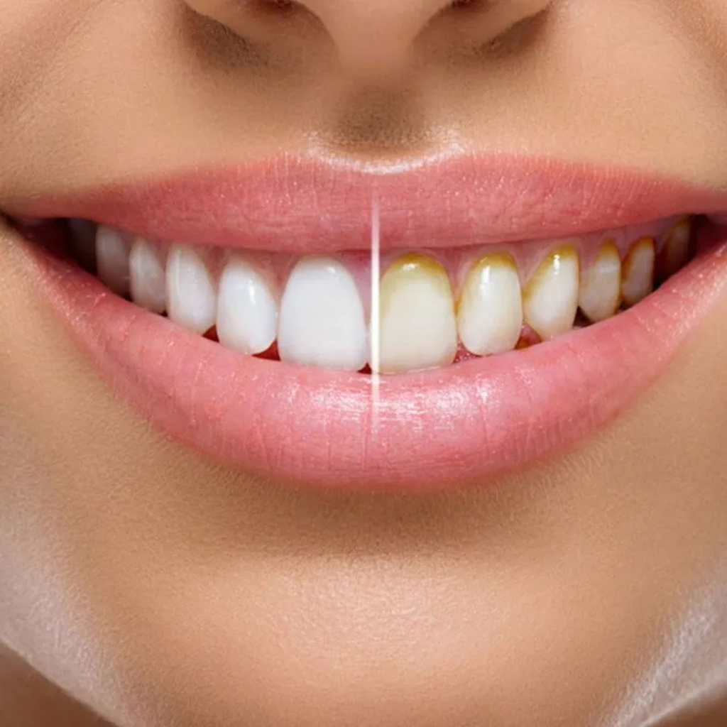 Miracle Smile – Irrigador dentário duplo