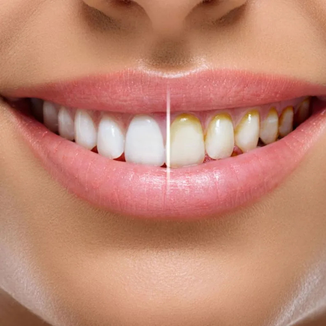 Miracle Smile – Irrigador dentário duplo